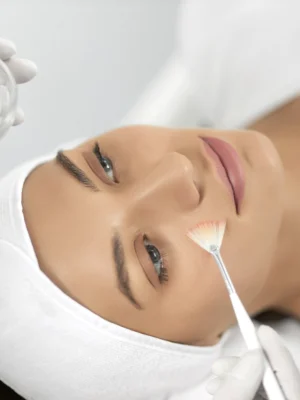 Peeling Químico Médico