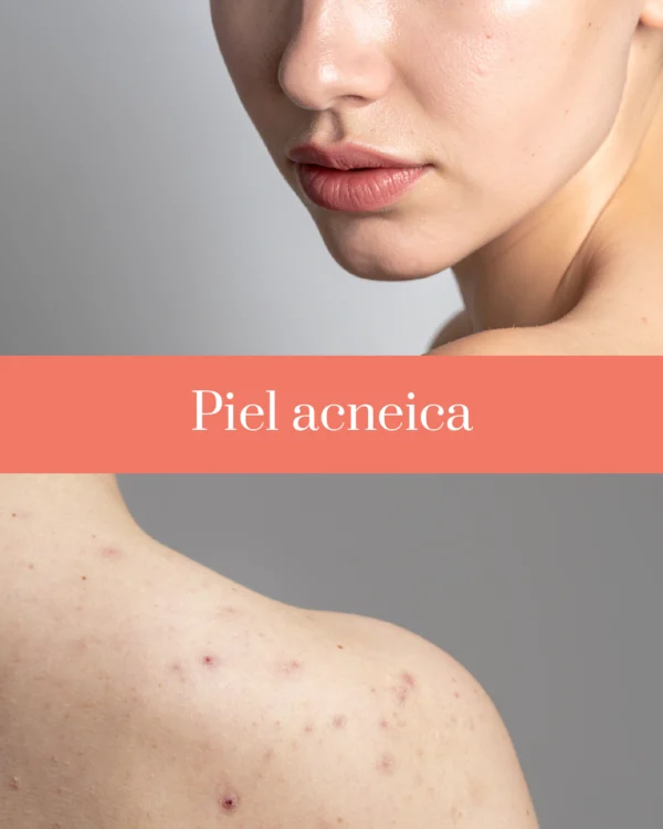 Skin Control Depilife España como tratar piel acneica Skin Control