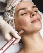 Bioestimulación facial con Exosomas