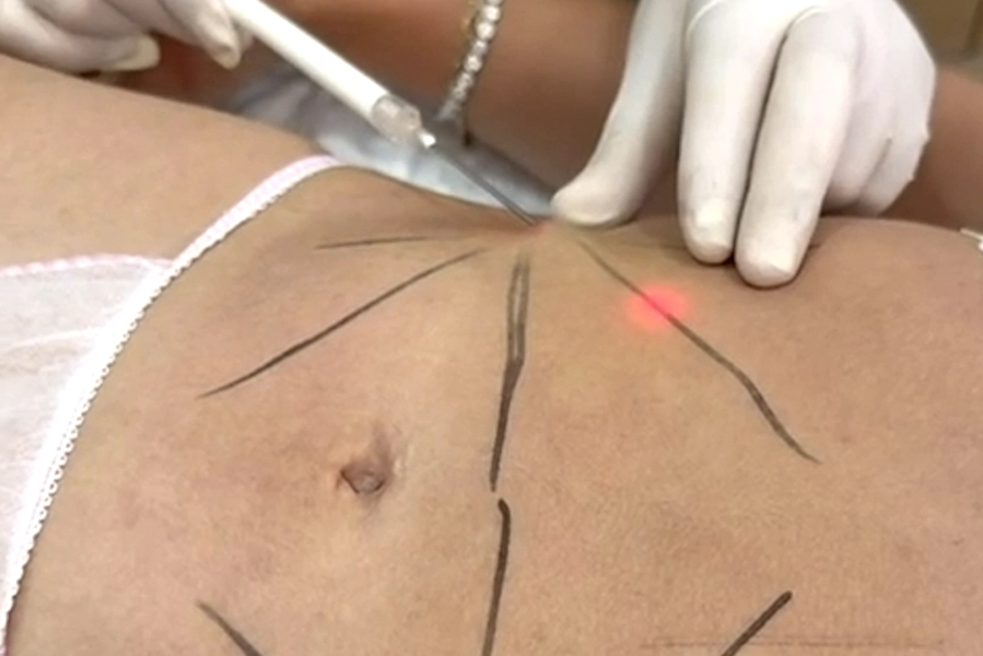 Endoláser Depilife España endolaser endolaser